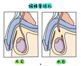 什么是结扎手术图片,生殖健康与生育控制的关键步骤解析